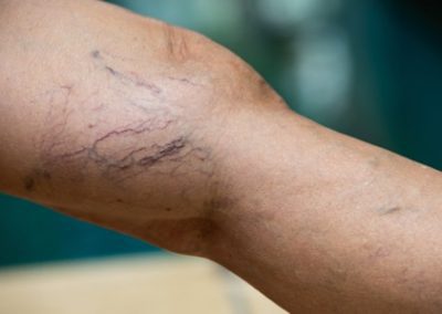 Venous Insufficiency