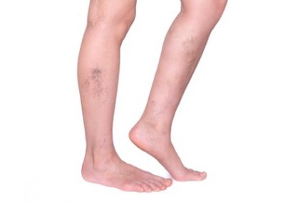 Venous Insufficiency