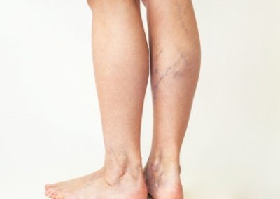 Venous Insufficiency