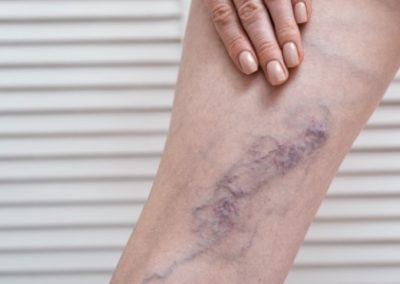 Venous Insufficiency