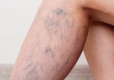 Venous Insufficiency