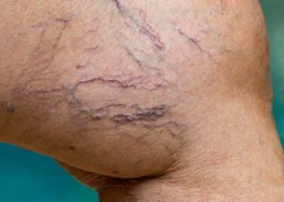 Venous Insufficiency
