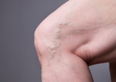 Venous Insufficiency