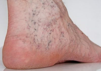 Venous Insufficiency