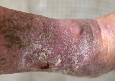 Venous Insufficiency