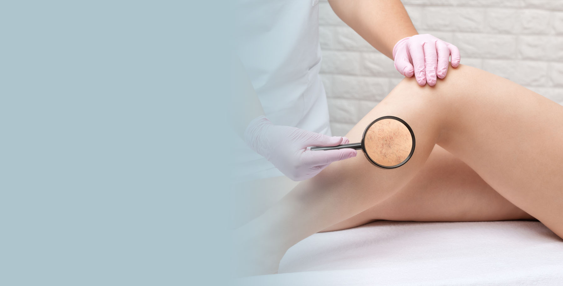 Varicose Vein Treatment
