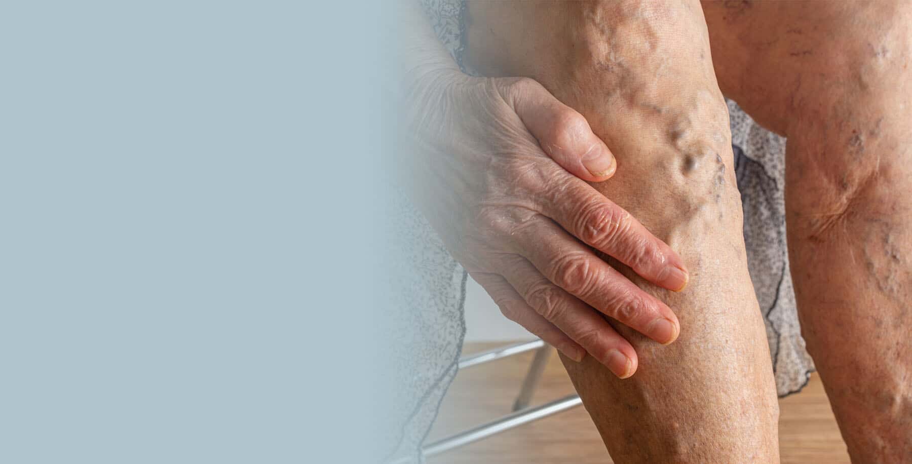 Vascular Ulcers