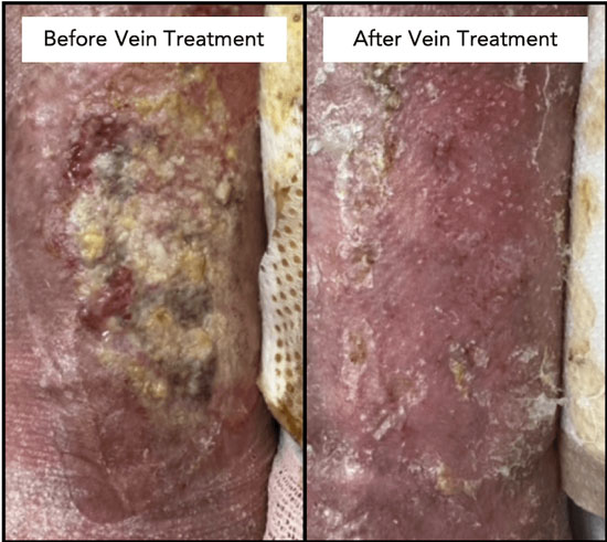 vascular ulcer