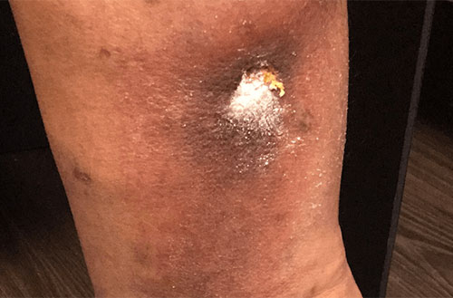 Venous Ulcer