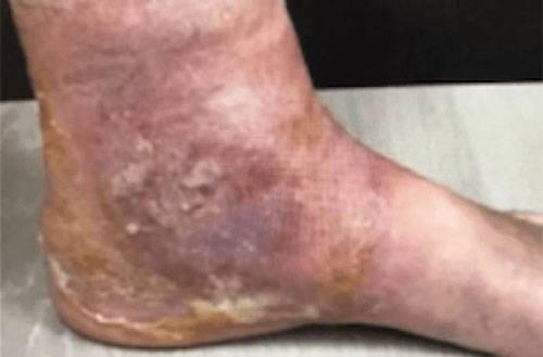 Venous Ulcer