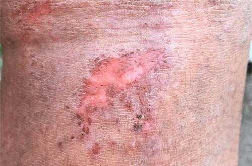 Venous Ulcer
