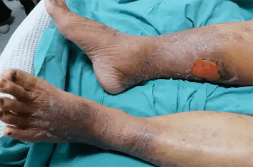 Venous Ulcer